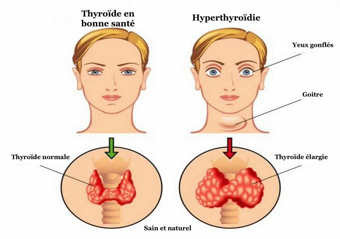 Comment Savoir Si Votre Thyroïde Cause La Perte De Cheveux