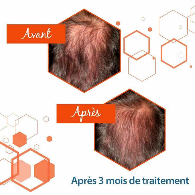 Le Massage Du Cuir Chevelu Favorise-t-il La Croissance Des Cheveux Mythe Et Faits